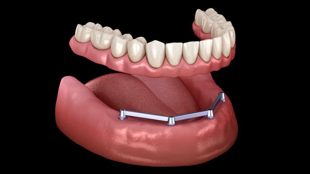 implant supported overdentures | Serenity Dental CQ | Serenity Dental CQ