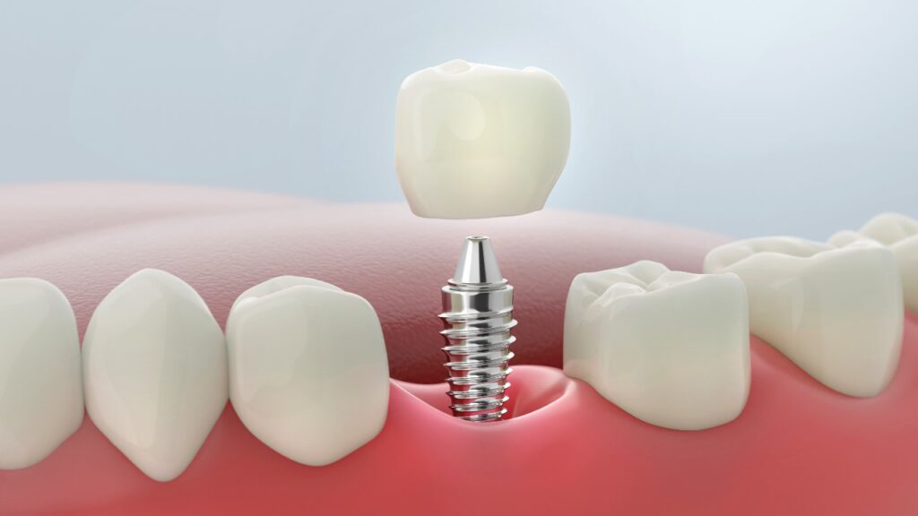 single tooth implant | Serenity Dental CQ | Serenity Dental CQ